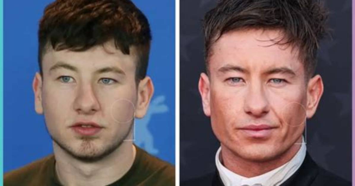 Barry Keoghan's Transformation: Exploring the Face Surgery Rumors