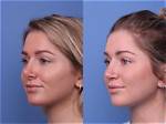 Before and After Photos and Surgery Details