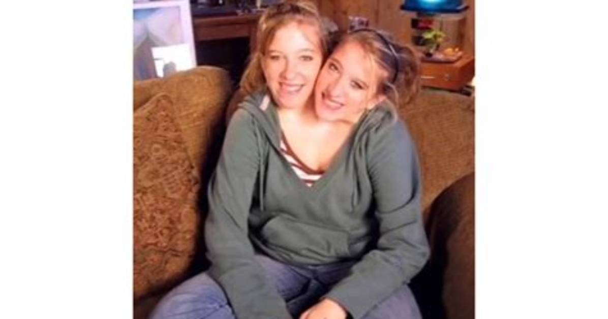 Did the Hensel Twins Pass Away? Understanding Their Journey