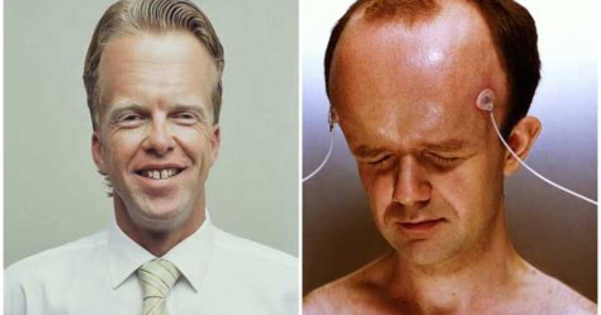 Discover the Secrets Behind the Largest Forehead in the World