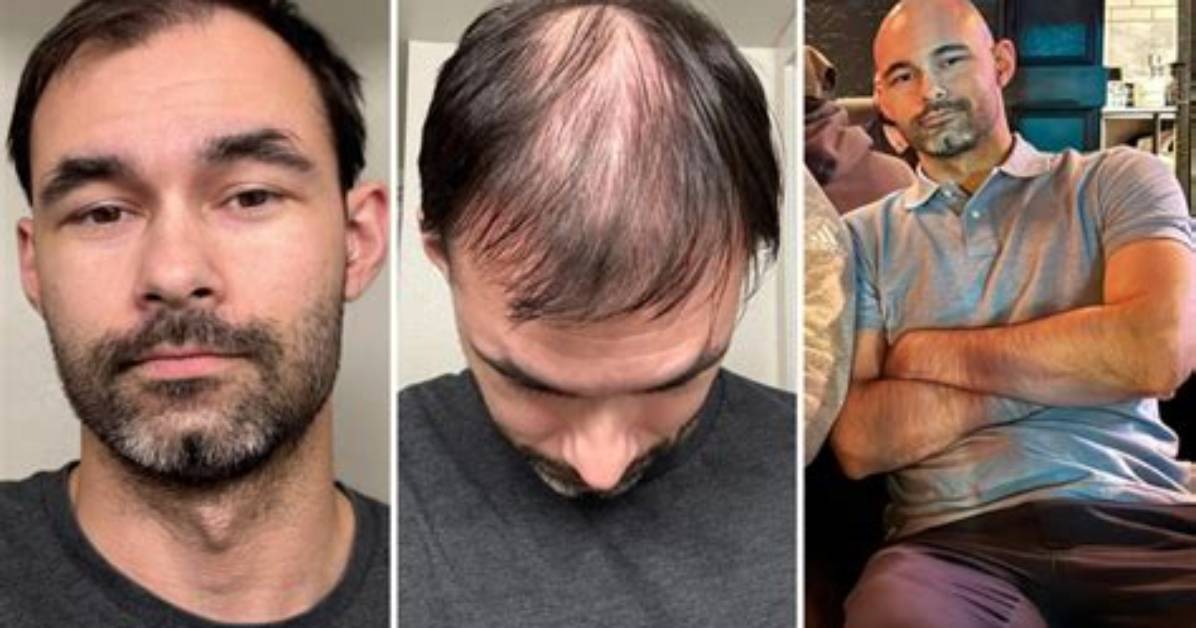Embracing Baldness: the Journey of Bald Ppl