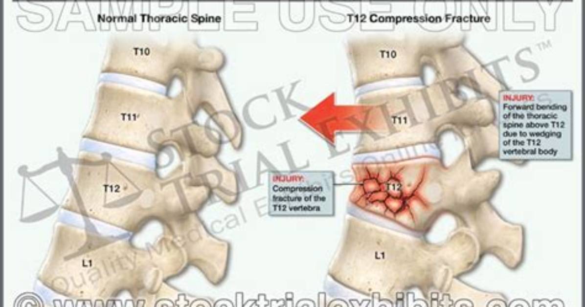Essential Guide to T12 Vertebral Fracture Treatment