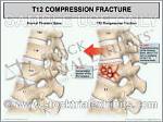 Essential Guide to T12 Vertebral Fracture Treatment