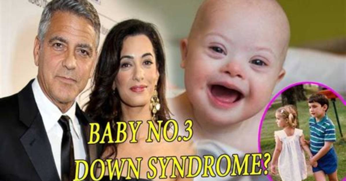 George Clooney's Son: Understanding Down Syndrome and Its Impact