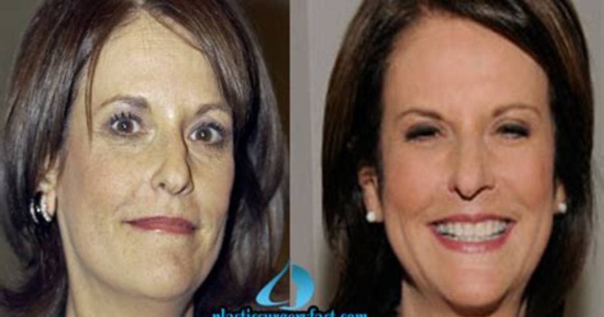 Gloria Borger's Facelift: Before and After Photos and Details