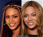 Has Beyonce Had a Nose Job or Plastic Surgery?