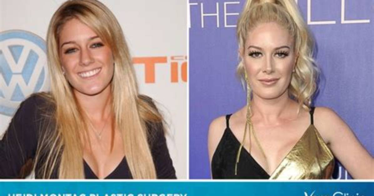 Heidi Montag Plastic Surgery: Before and After Transformation
