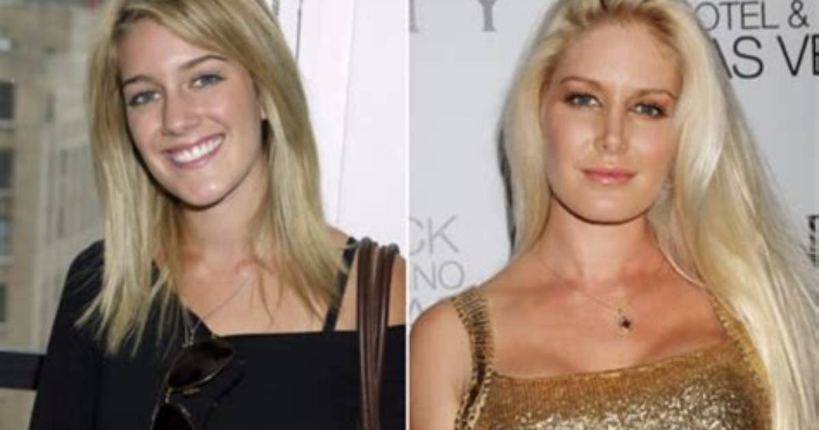 Heidi Montag's Plastic Surgery Transformation: Before and After the Knife