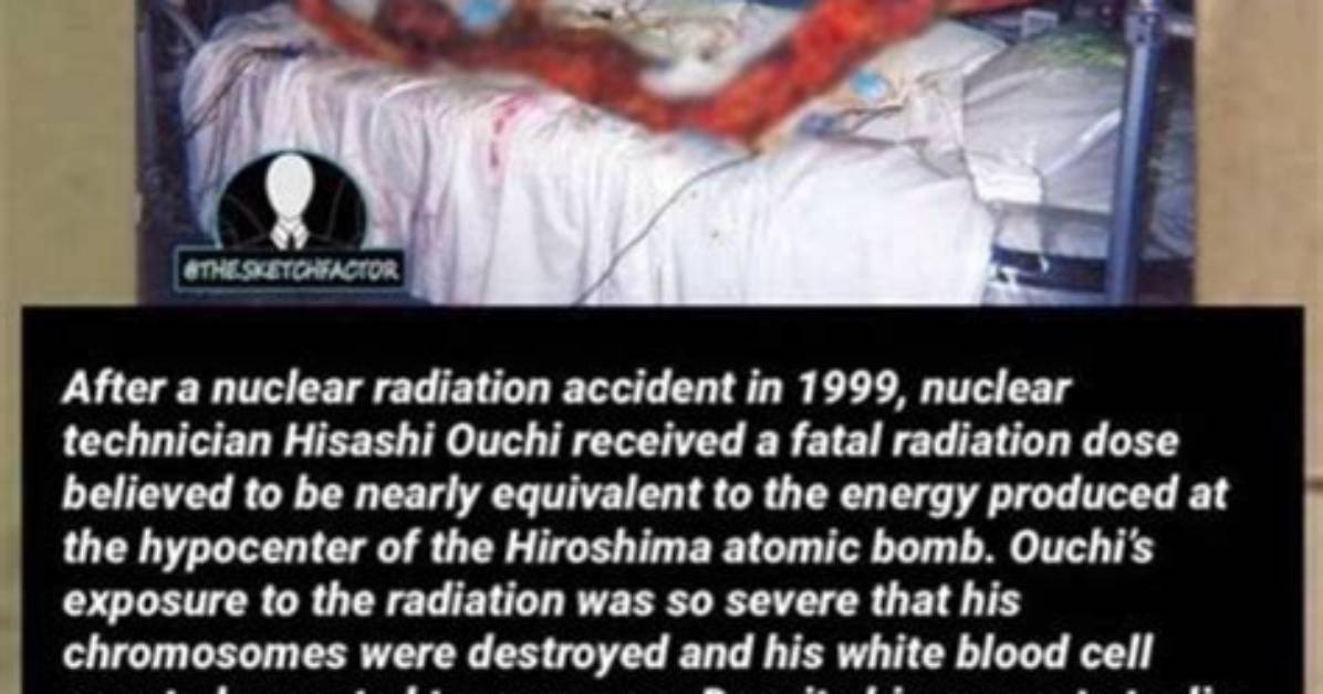 Hisashi After Radiation: a Journey of Resilience and Recovery