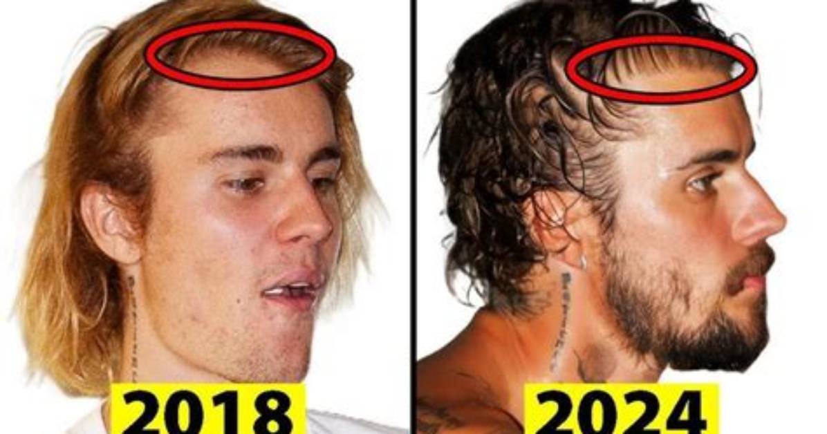 Is Justin Bieber Aging Too Fast? the Surprising Transformation
