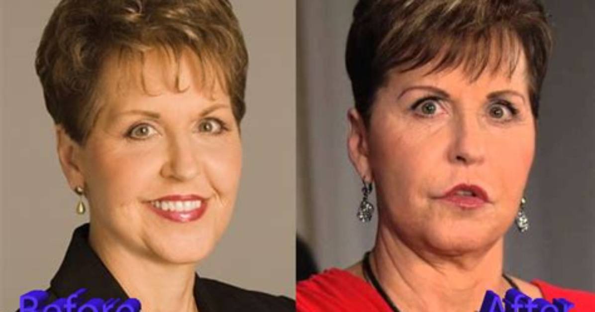 Joyce Meyer and the Plastic Surgery Journey