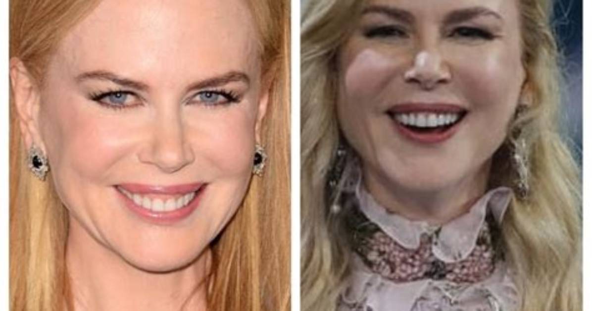 Nicole Kidman Surgery: a Closer Look at the Hollywood Star's Transformation