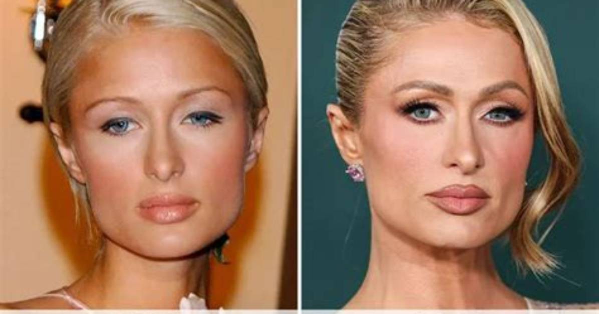 Paris Hilton's Nose: the Ultimate Guide to Her Changing Appearance