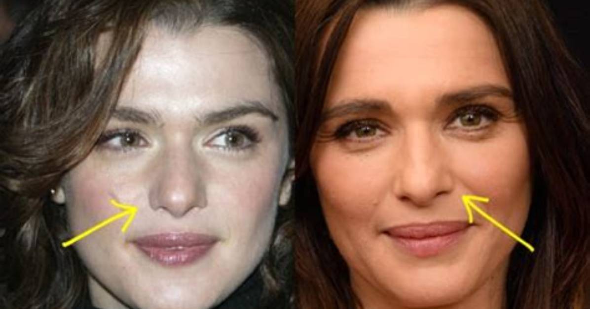 Rachel Weisz Plastic Surgery: Did She or Didn't She?