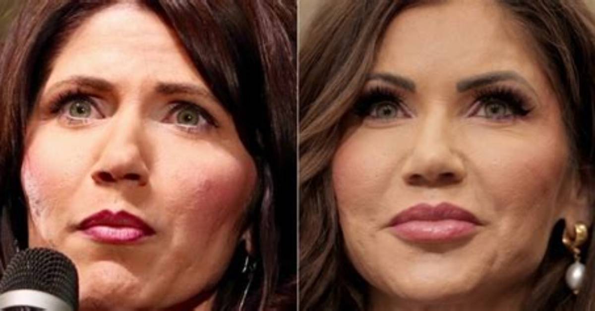 Reconstructive Surgery on Kristi Noem: a Visual Timeline