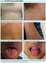 Strep a Scarlet Fever Outbreak: How Did Hanna Roap Die? Cause of Death Explained