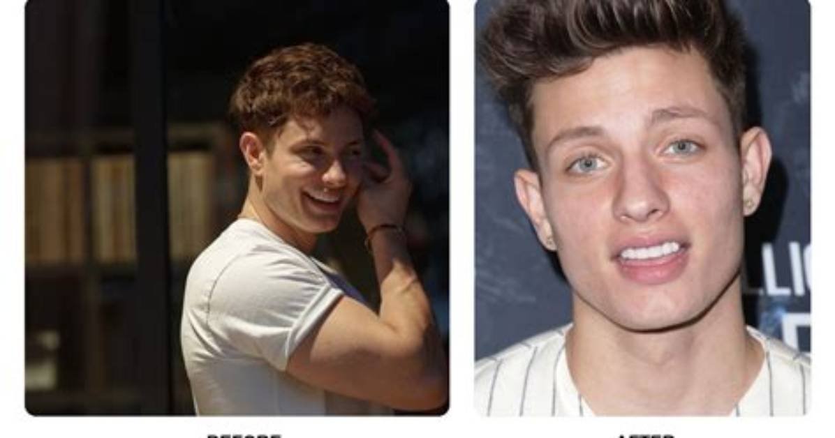 Transformative Smile: Matt Rife Teeth Before and After