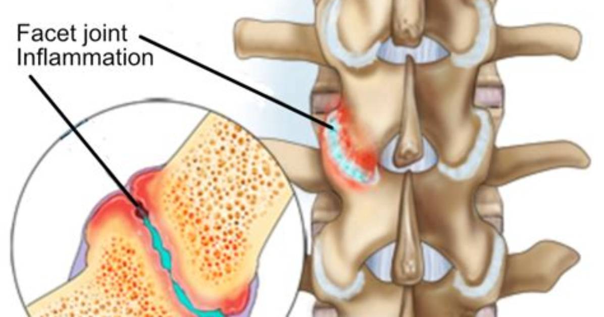 Understand Hypertrophic Facet Arthropathy: a Comprehensive Medical Definition
