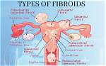 Understanding Uterine Fibroids in Relation to Brittney Griner: a Trans Perspective
