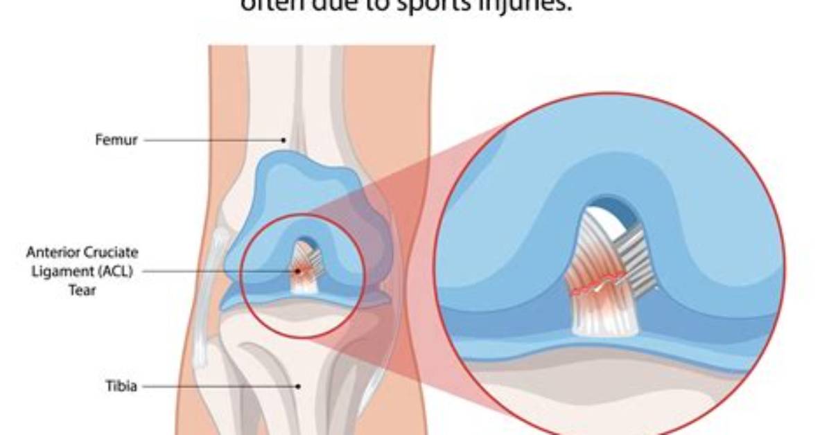 Unraveling the Depths of Acl Tears and Triumph