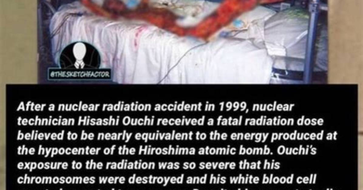 Unveiling Hisashi Ouchi's Radiation-Burned Images