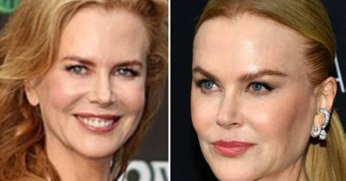 Unveiling the Truth: Did Nicole Kidman Have Plastic Surgery?