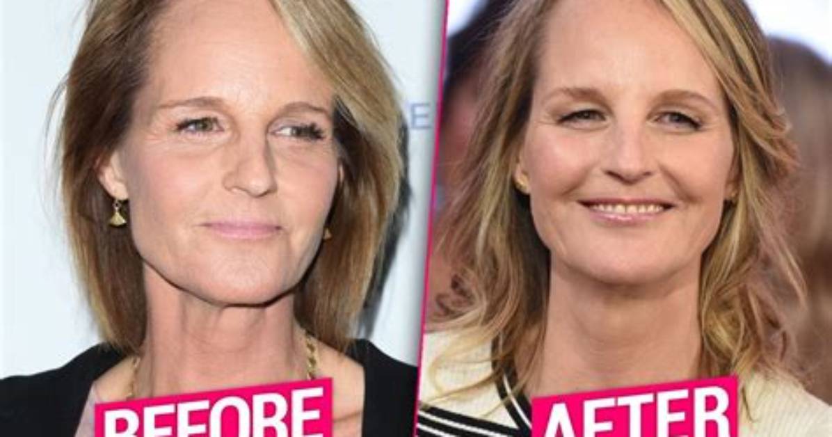 What Happened to Helen Hunt Face? Has She Done Plastic Surgery