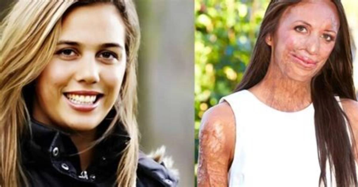 What Happened to Turia Pitt? Accident Details- Where Is Australian Engineer Now?