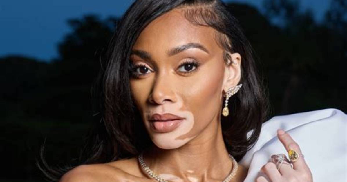 What Really Happened to Winnie Harlow? the Surprising Truth